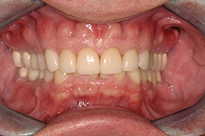 Full Mouth Reconstruction After Photo
